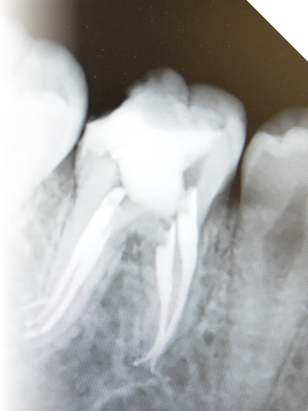根管治療の特長