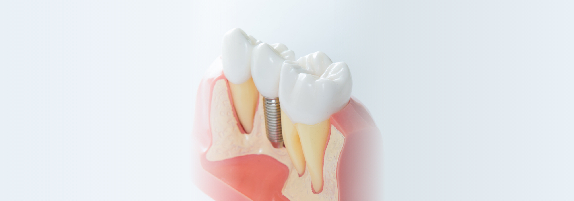 IMPLANT/インプラント