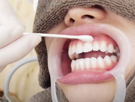歯ぐきの保護